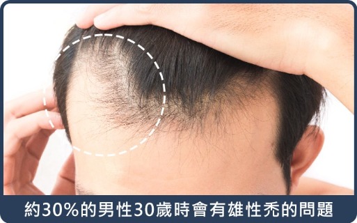 毛囊萎縮-根據統計男性到達30歲時，約有30%的人有雄性禿的問題-H&H