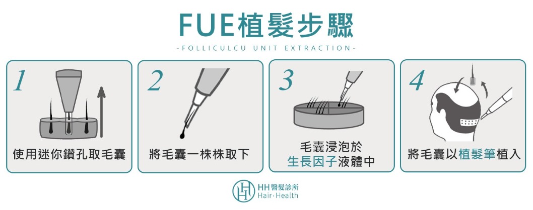 植髮-FUE植髮手術4步驟-HH醫髮診所