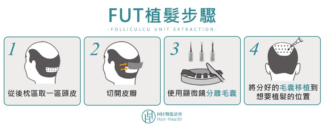 植髮-FUT植髮手術4步驟-HH醫髮診所