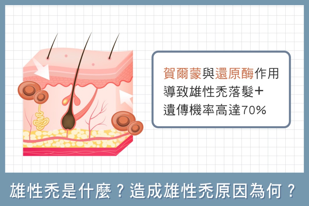 雄性禿-雄性禿是什麼？造成雄性禿原因為何？-HH醫髮診所